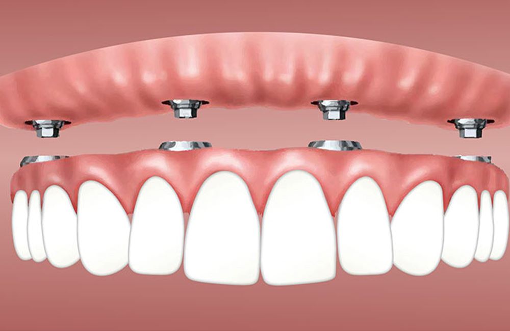 all-on-4 dental implants-turkey-antalya