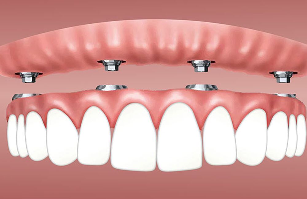 all-on-4 dental implants all-on-4 dental implants-turkey-antalya
