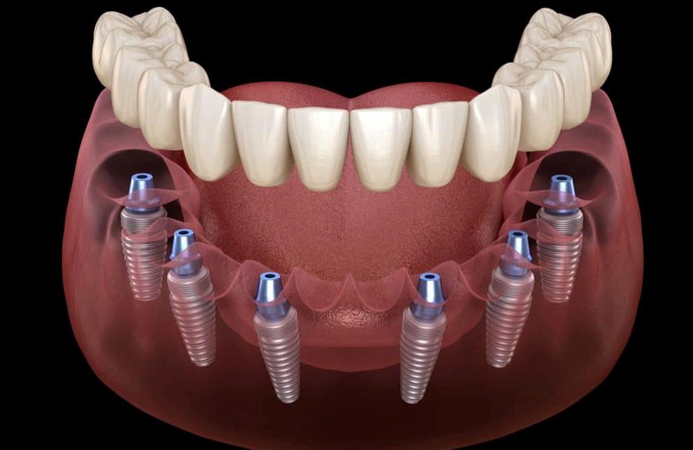 All on Six Dental Implants Procedure Antalya