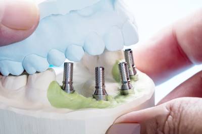 the Advantages & Disadvantages of All on Four (4) Dental Implants
