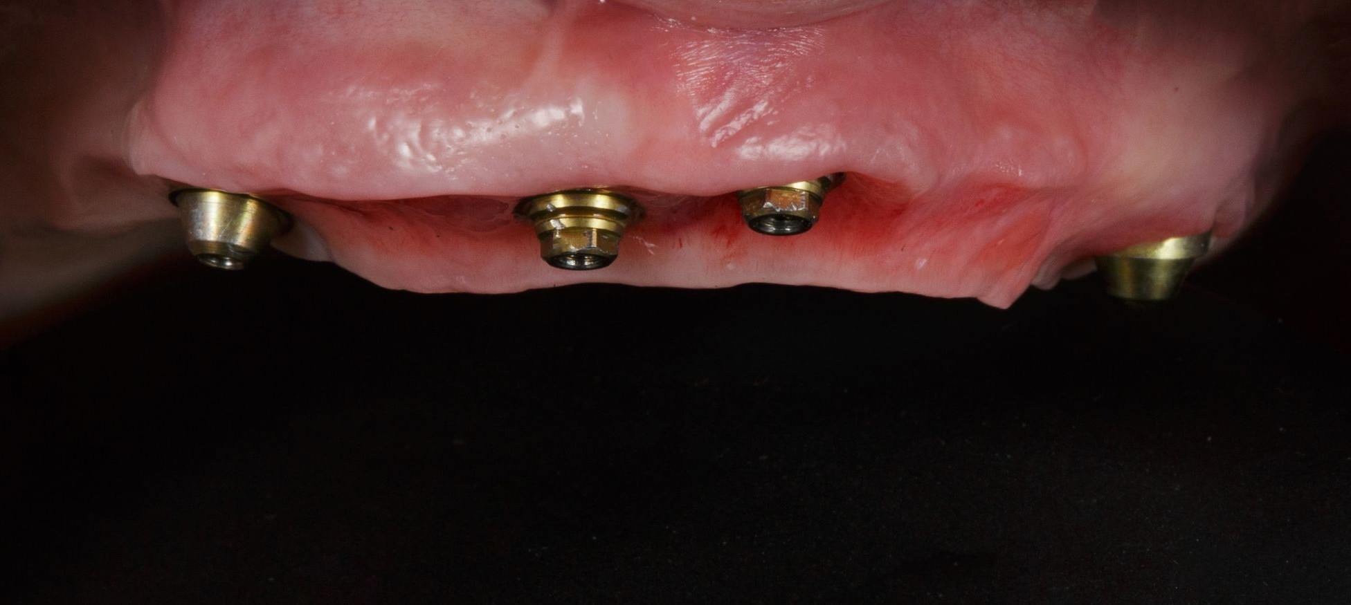How painful is All-on-4 dental implants? How painful is All-on-4 dental implants?-turkey-antalya