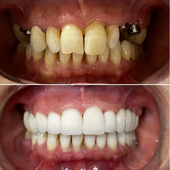 all-on-6 dental implants-before-after-turkey