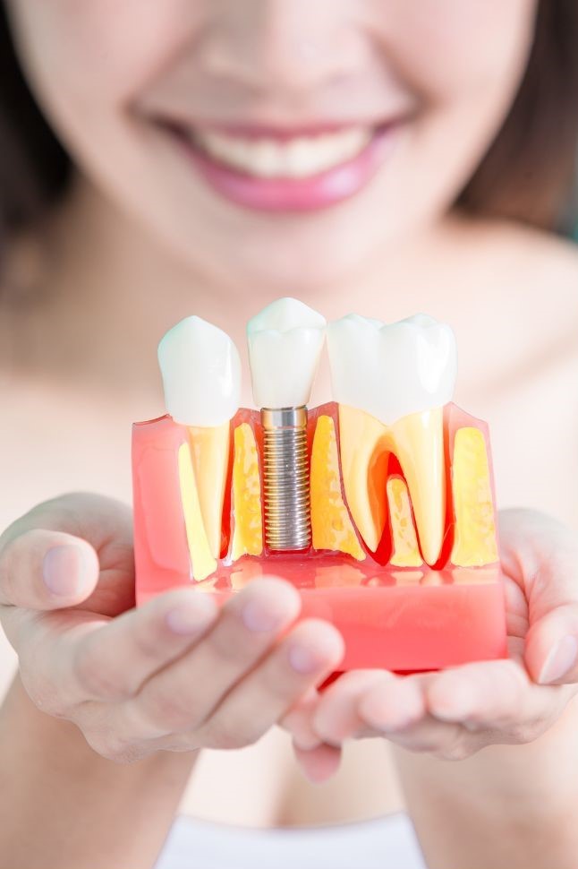 Is It Worth Getting Dental Implants in Turkey?