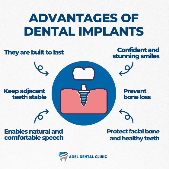 dental implant benefits-antalya-turkey