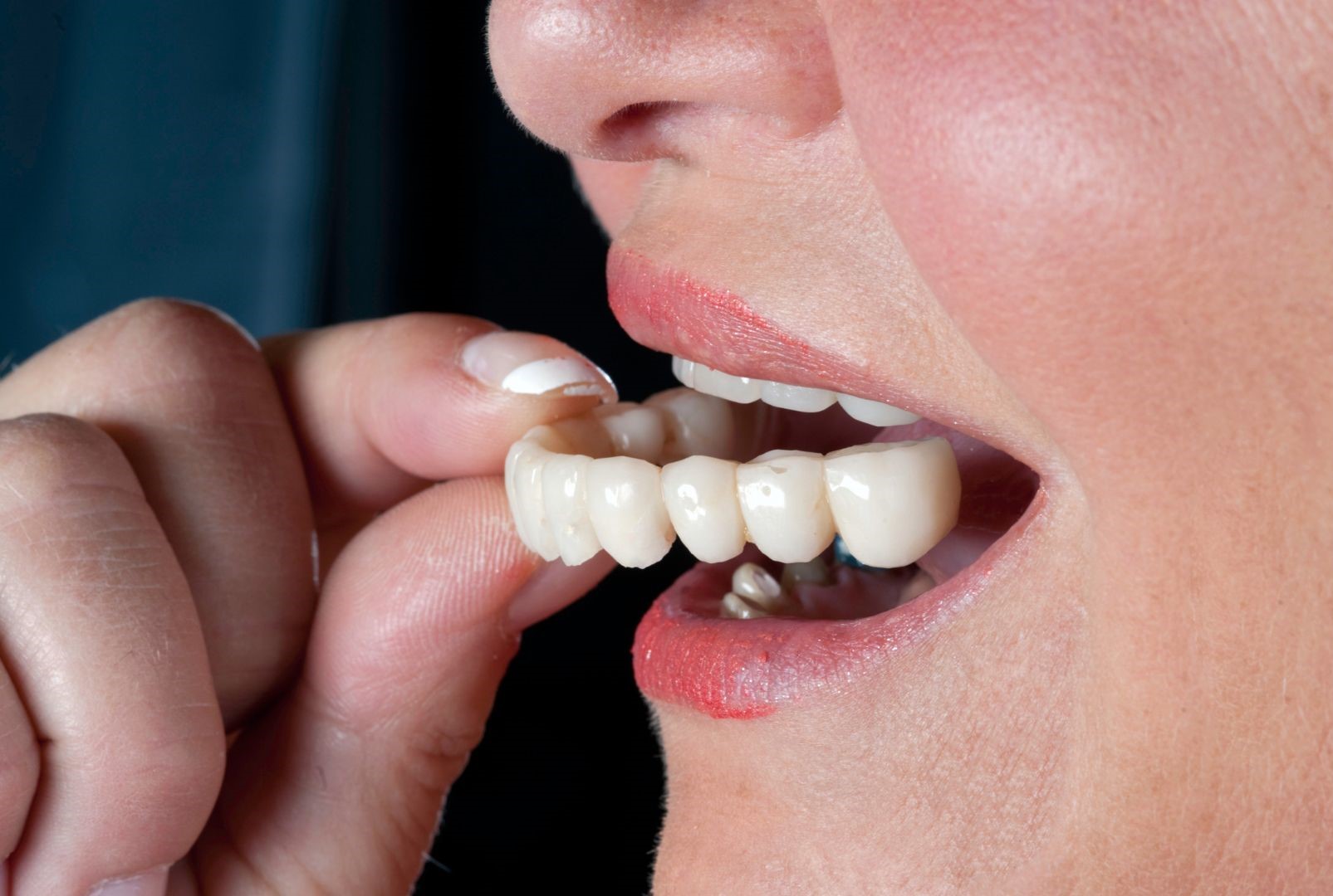 Will I be without teeth during the dental implant treatment?