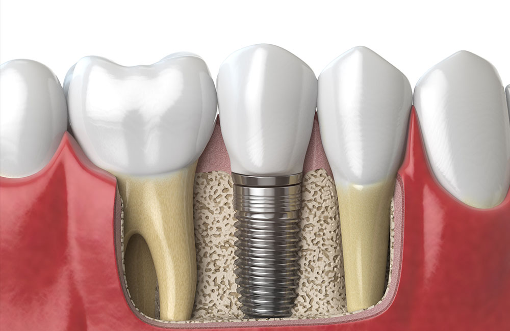 dental-implant dental-implant