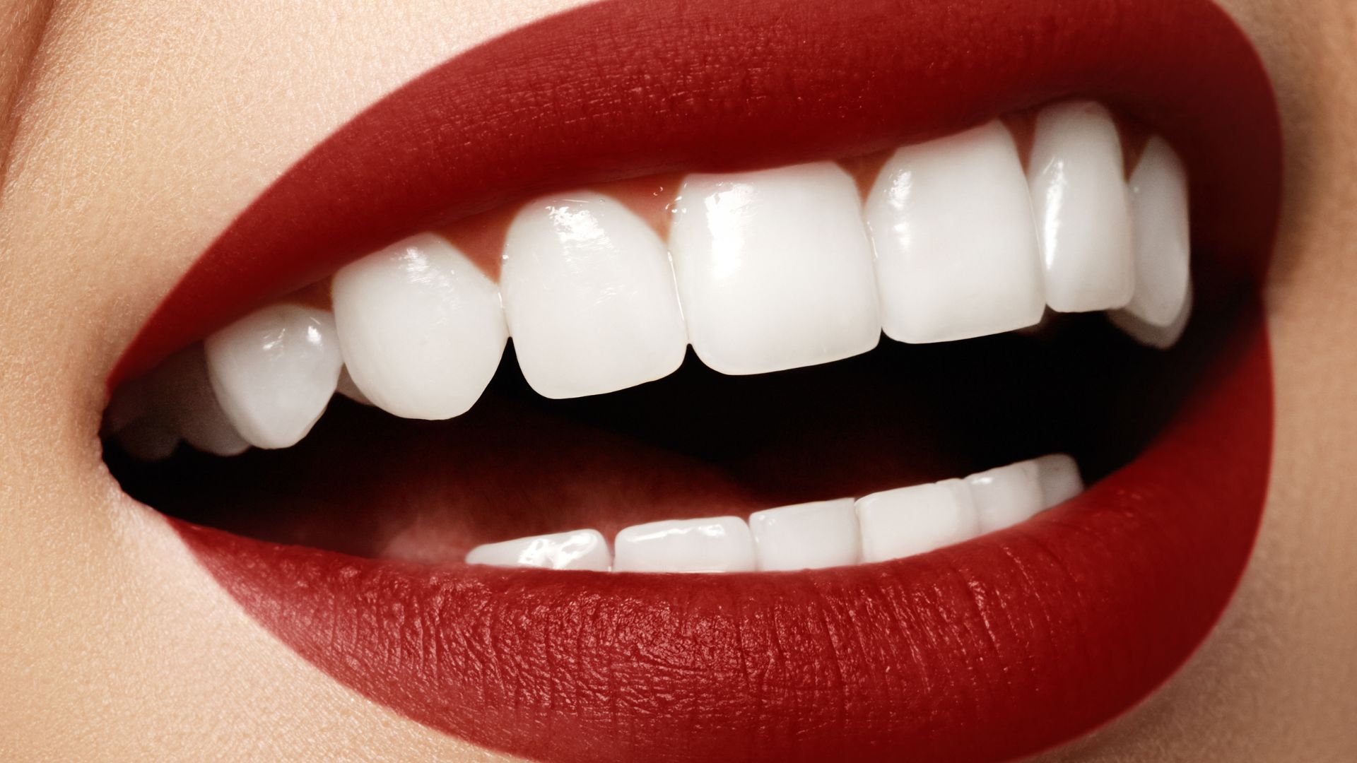 teeth-whitening at dentist in Antalya Turkey?