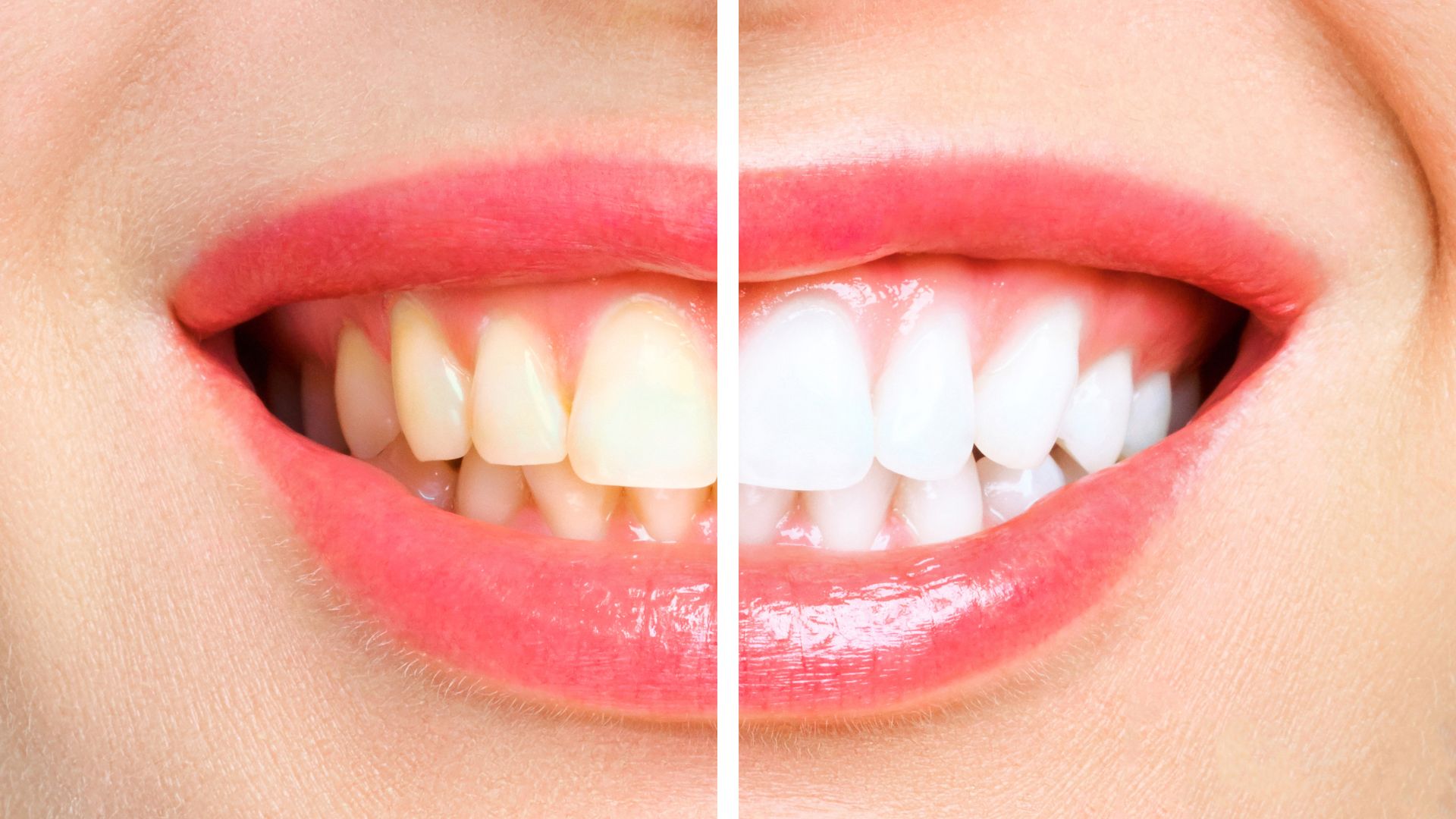 how-to-remove-yellow-stains-from-teeth-turkey-antalya